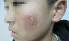 白癜风是什么样子?